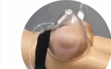 Diploma in Butt Lift Vacuum Therapy